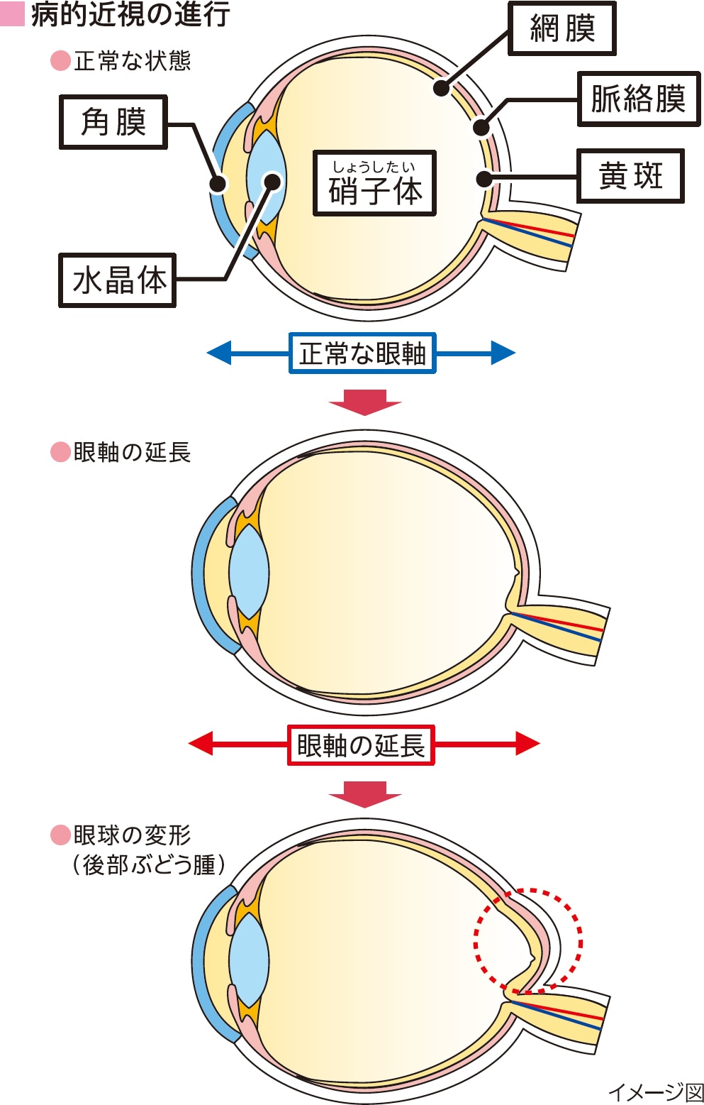 的 近視 病