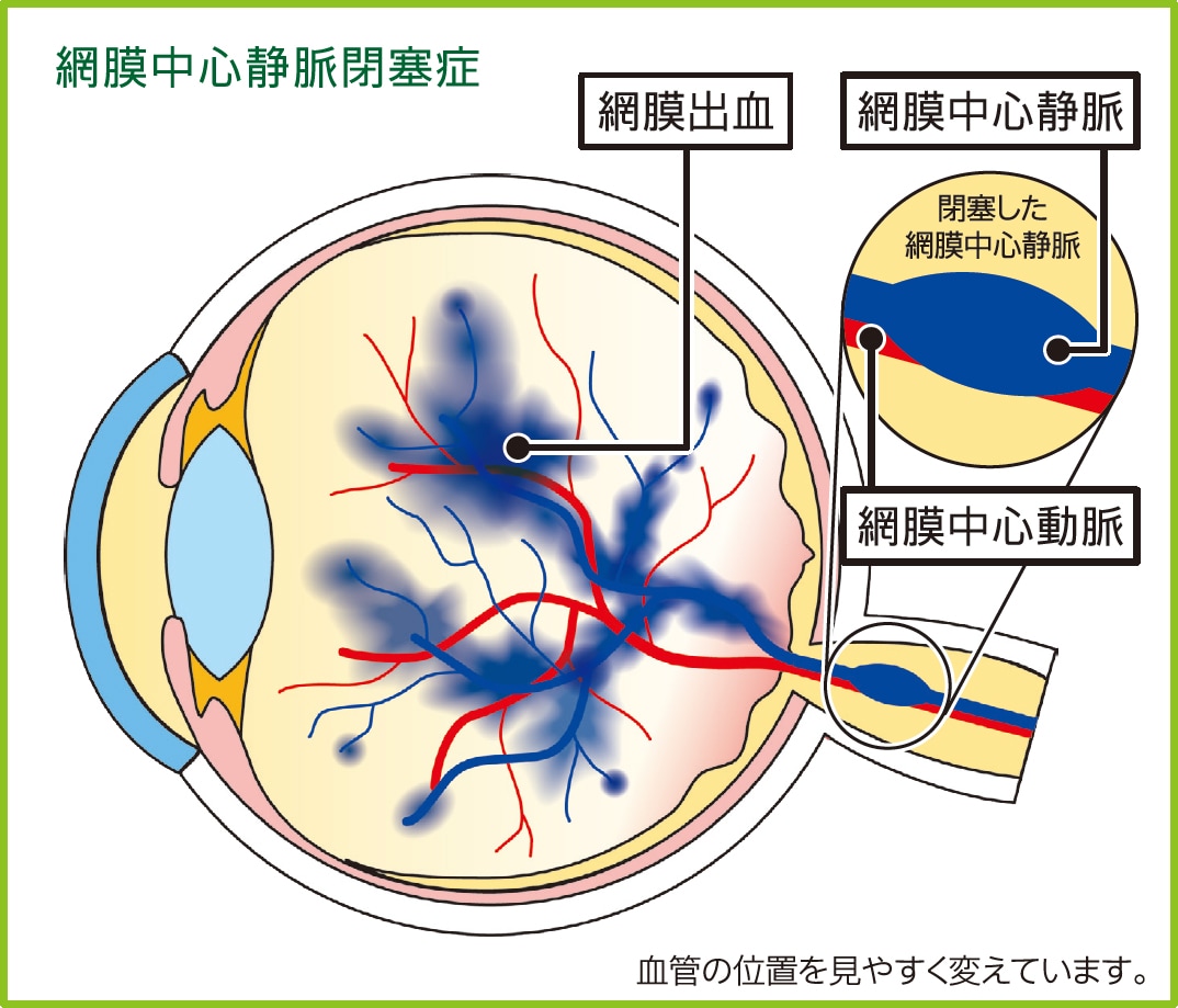 網膜中心静脈閉塞症