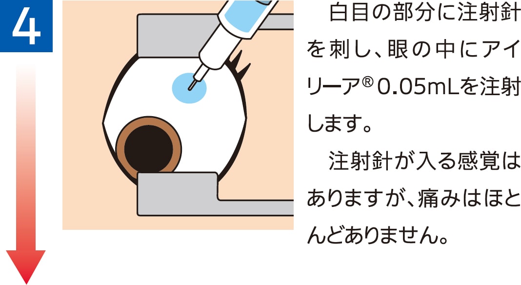 治療当日のながれ4