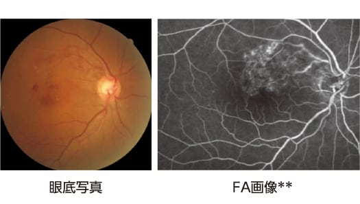 写真：毛細血管瘤（MA）を有する症例