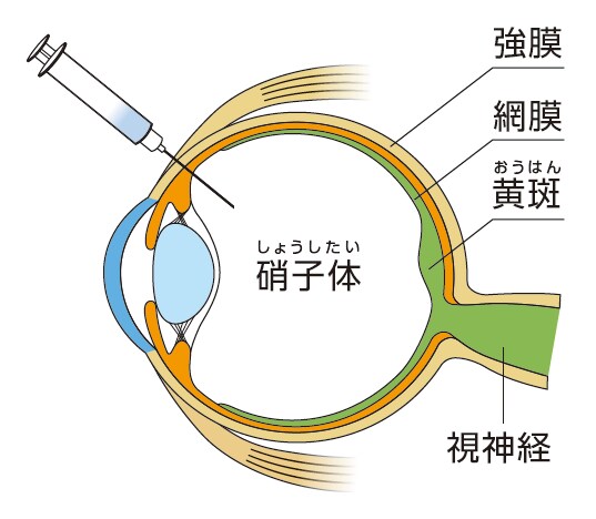 アイリーア®8mgによる治療法：硝子体内注射のイラスト