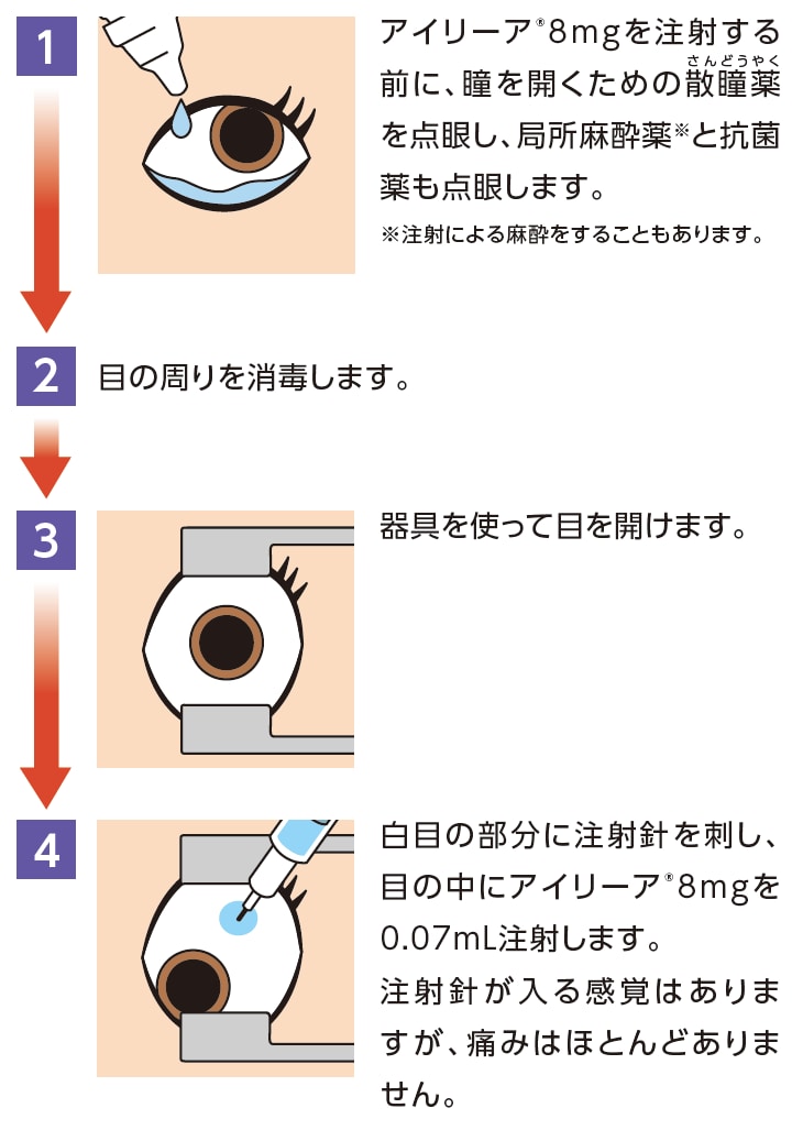 糖尿病黄斑浮腫：アイリーア®8mgによる投与方法の流れのイメージ図